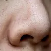 پکیج کامل تخصصی بینی